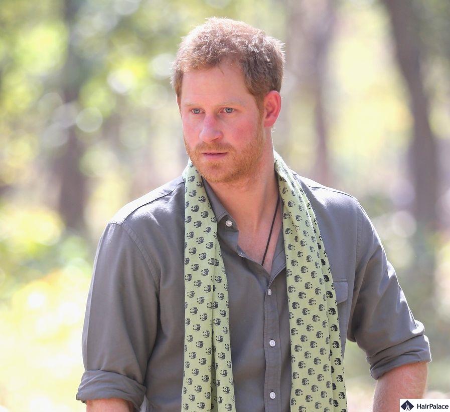 prince harry receding hairline