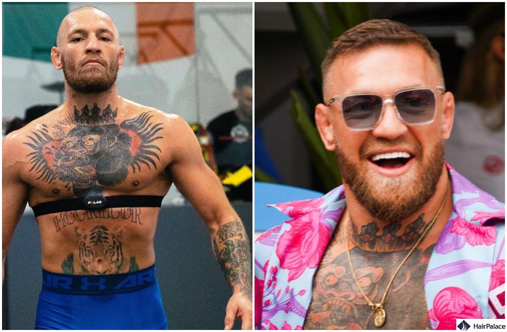 conor mcgregor before and after his hair transplant