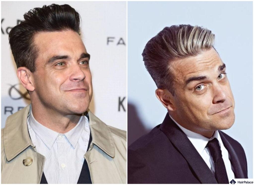 robbie williams before and after his hair transplant
