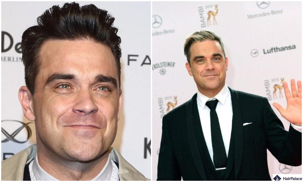 Robbie Williams hair transplant happened in 2013