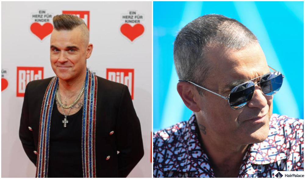 robbie williams hair loss got so bad that he's almost completely bald these days