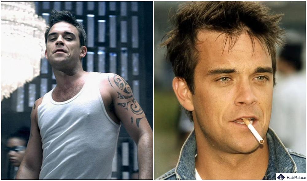 robbie williams had a receding hairline by the early 2000s