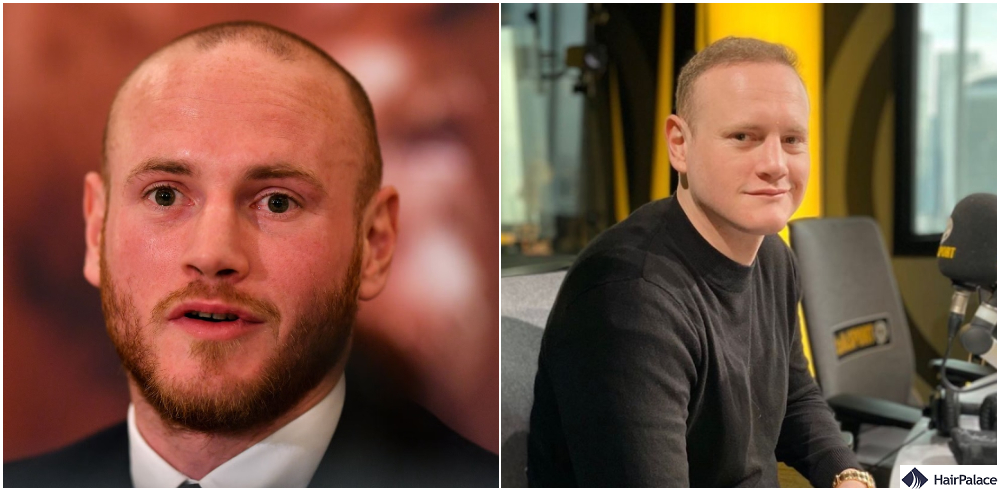 george groves hair transplant results look stunning