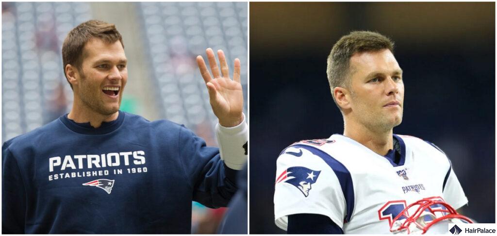 tom brady hair transplant before and after