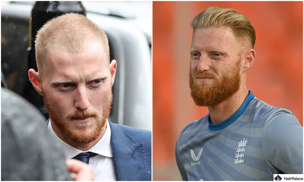 ben stokes hair transplant results