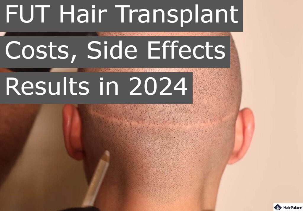 fut hair transplant costs side effects results in 2024