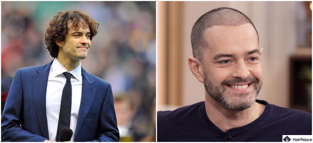 Lee mead hair transplant results