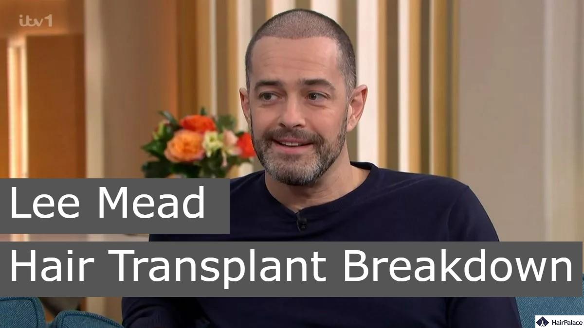 Lee Mead hair transplant breakdown