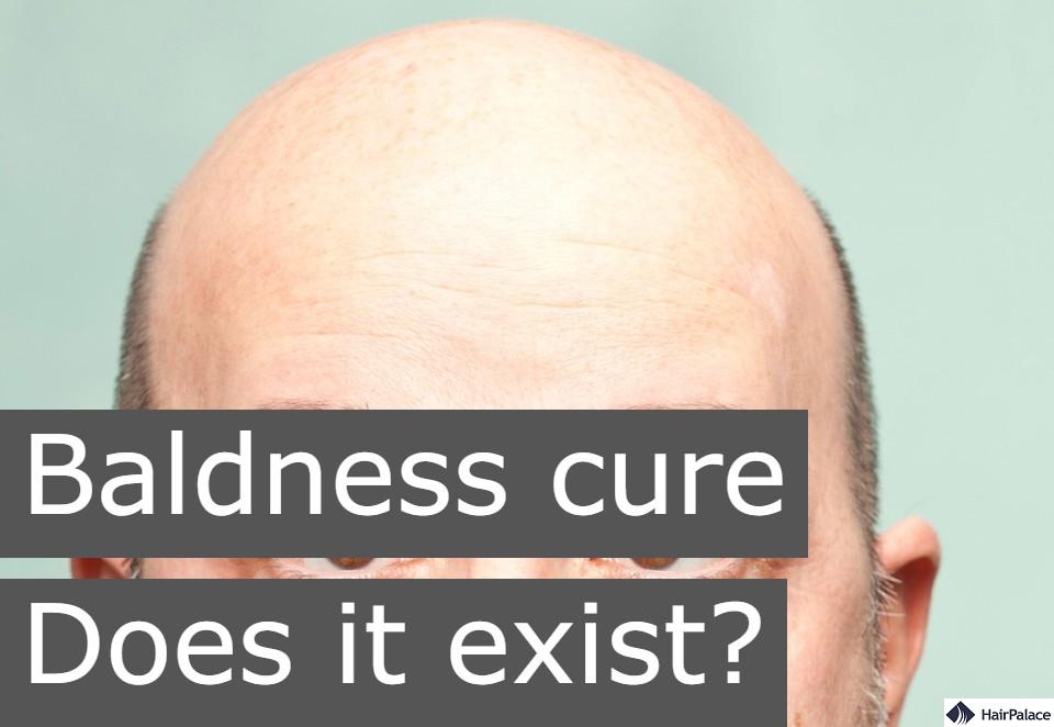 baldness cure, does it exist?