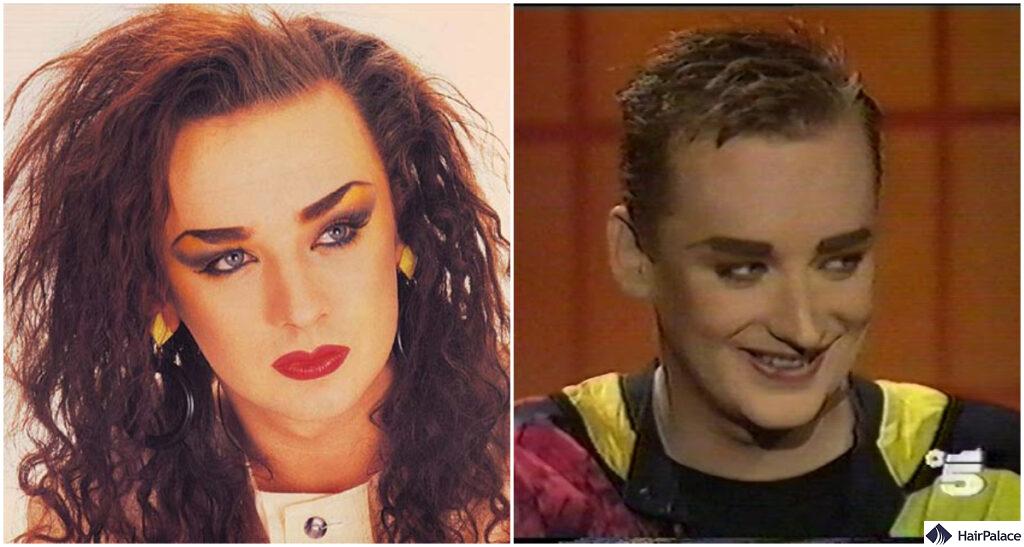 boy george before hair transplant