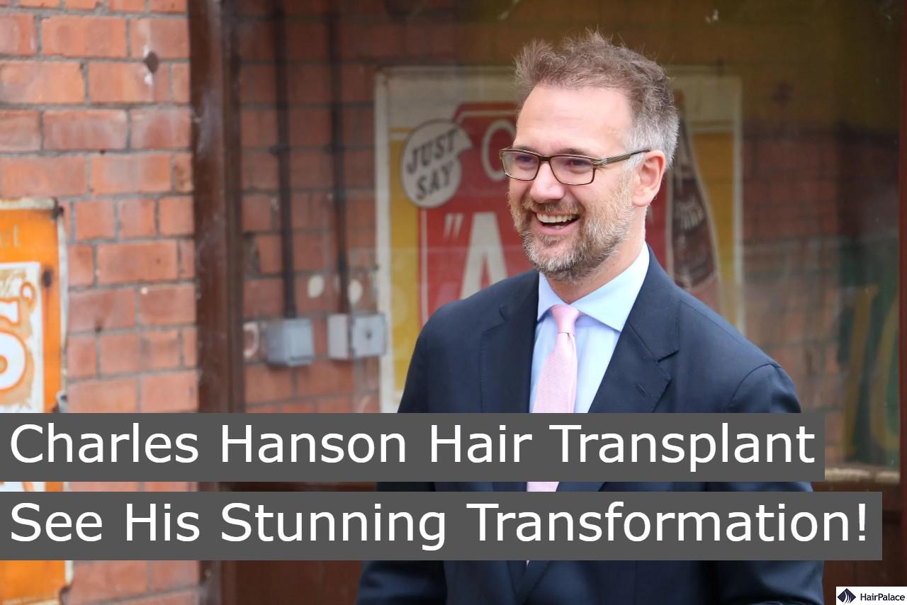 charles hanson hair transplant see his stunning transformation