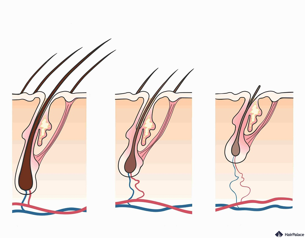 the process that leads to male pattern baldness