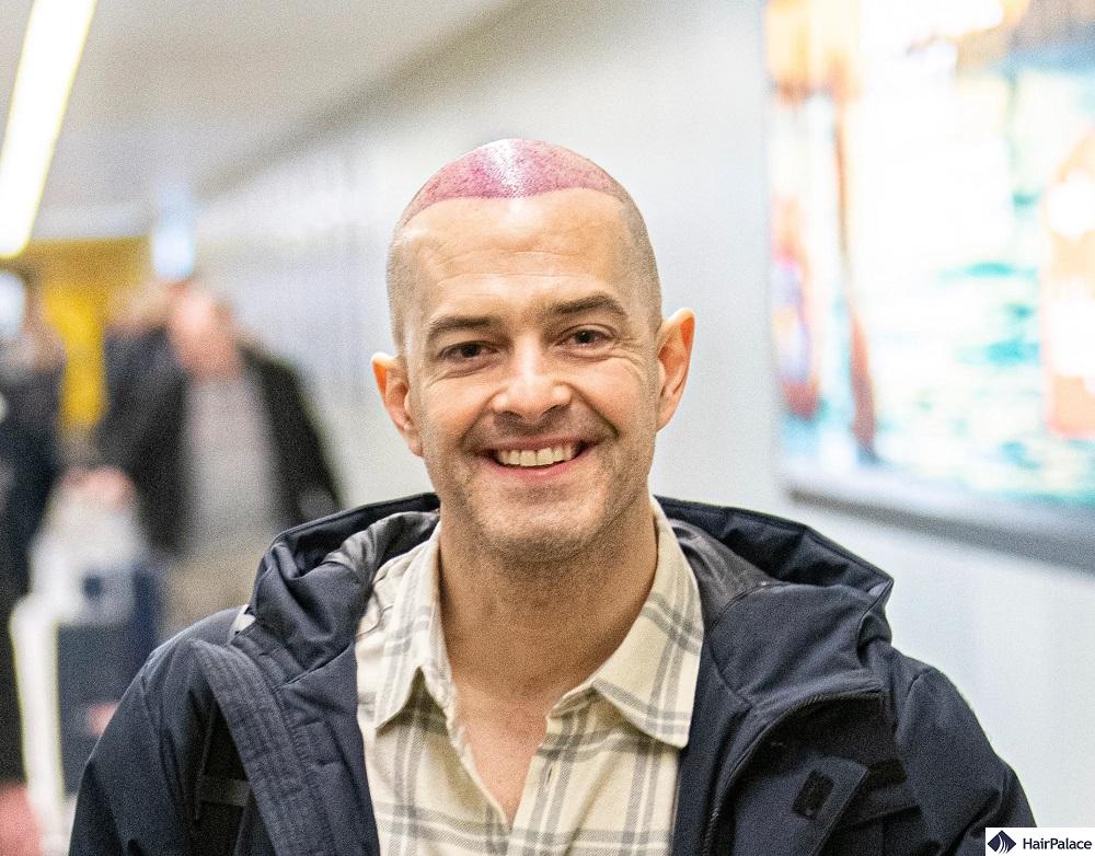 lee mead hair transplant before and after