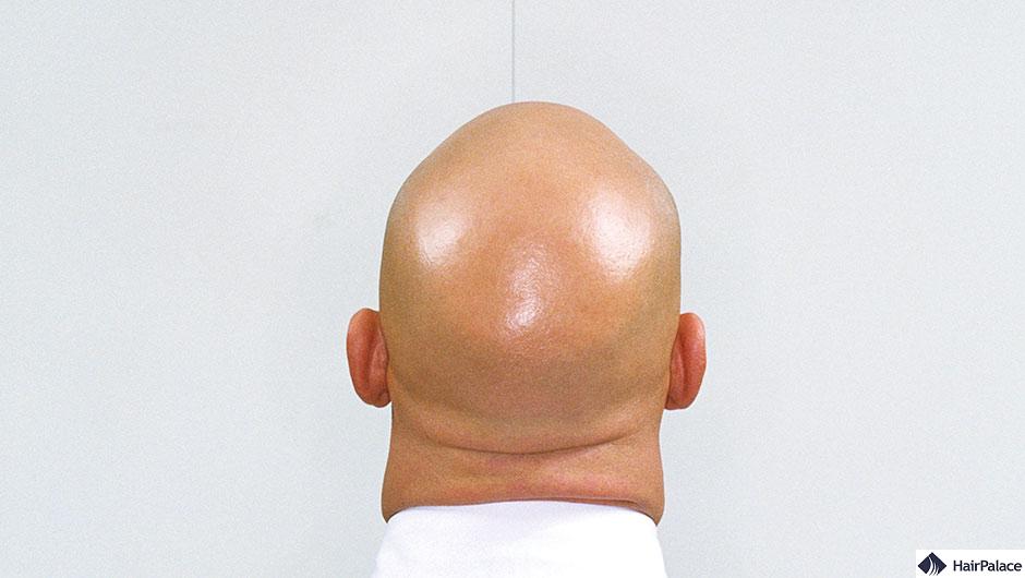 Genetic Hair Loss Is There a Baldness Gene