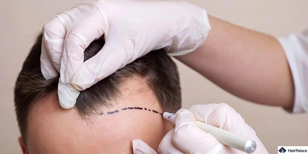 drawing hairline before hair transplant