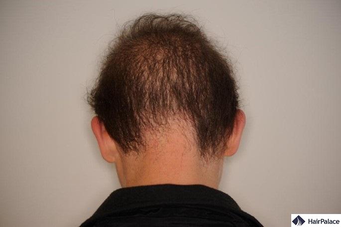 how to measure retrogade alopecia