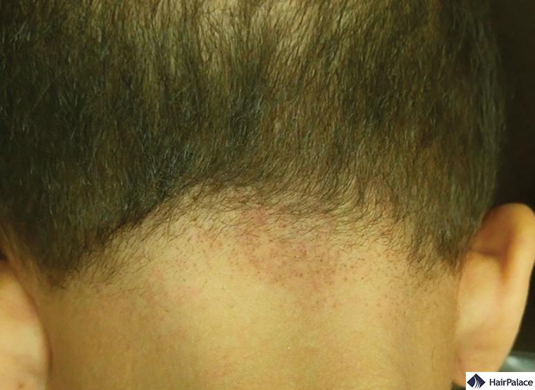 retrogade alopecia