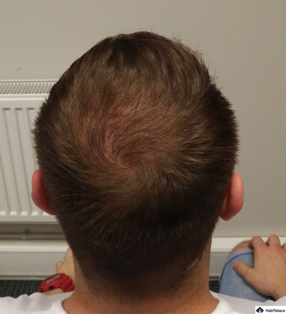 crown hair transplant after 8 months