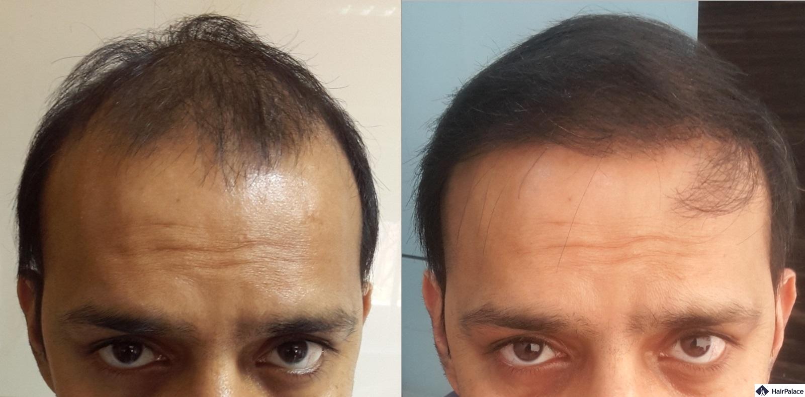 synthetic hair implant results for men