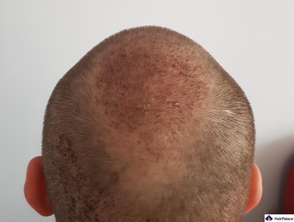 crown hair transplant after one week