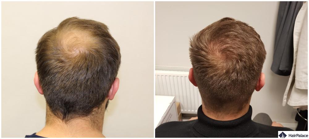 hair transplant results