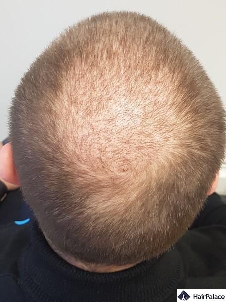 crown hair transplant surgery after four months