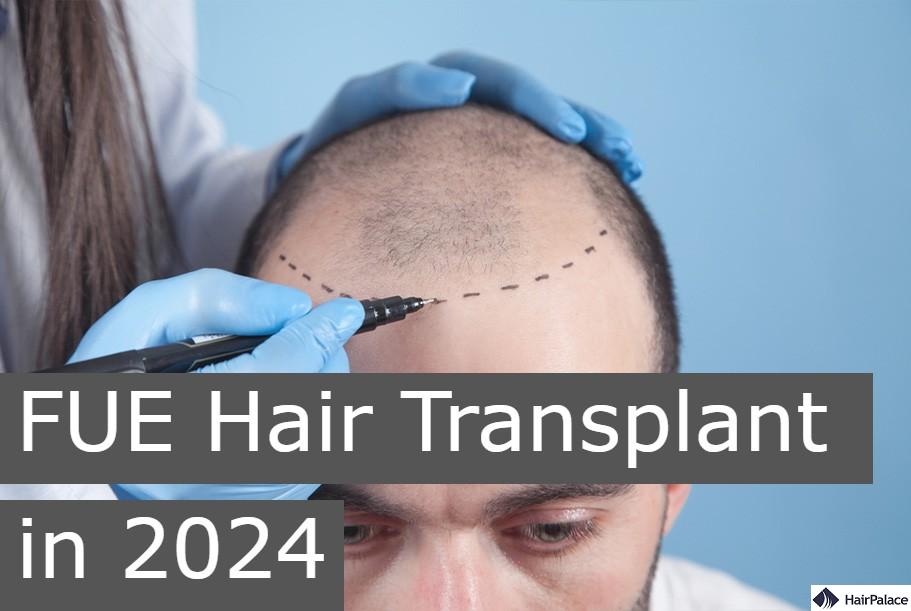 fue hair transplant in 2024