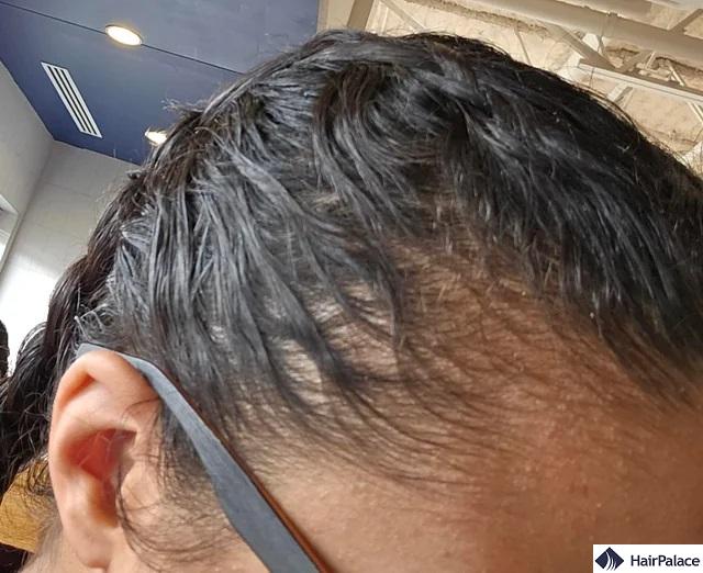 signs of man bun hair loss