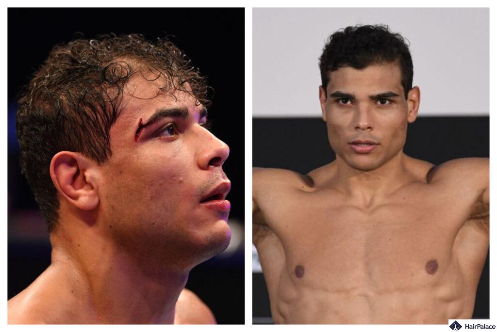 paulo costa hair transplant before and after