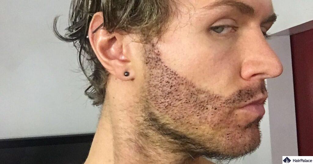 Beard Transplant UK: Procedure, Cost & Results in 2025