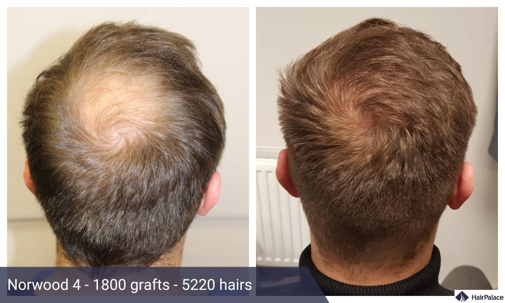 crown hair transplant with fue