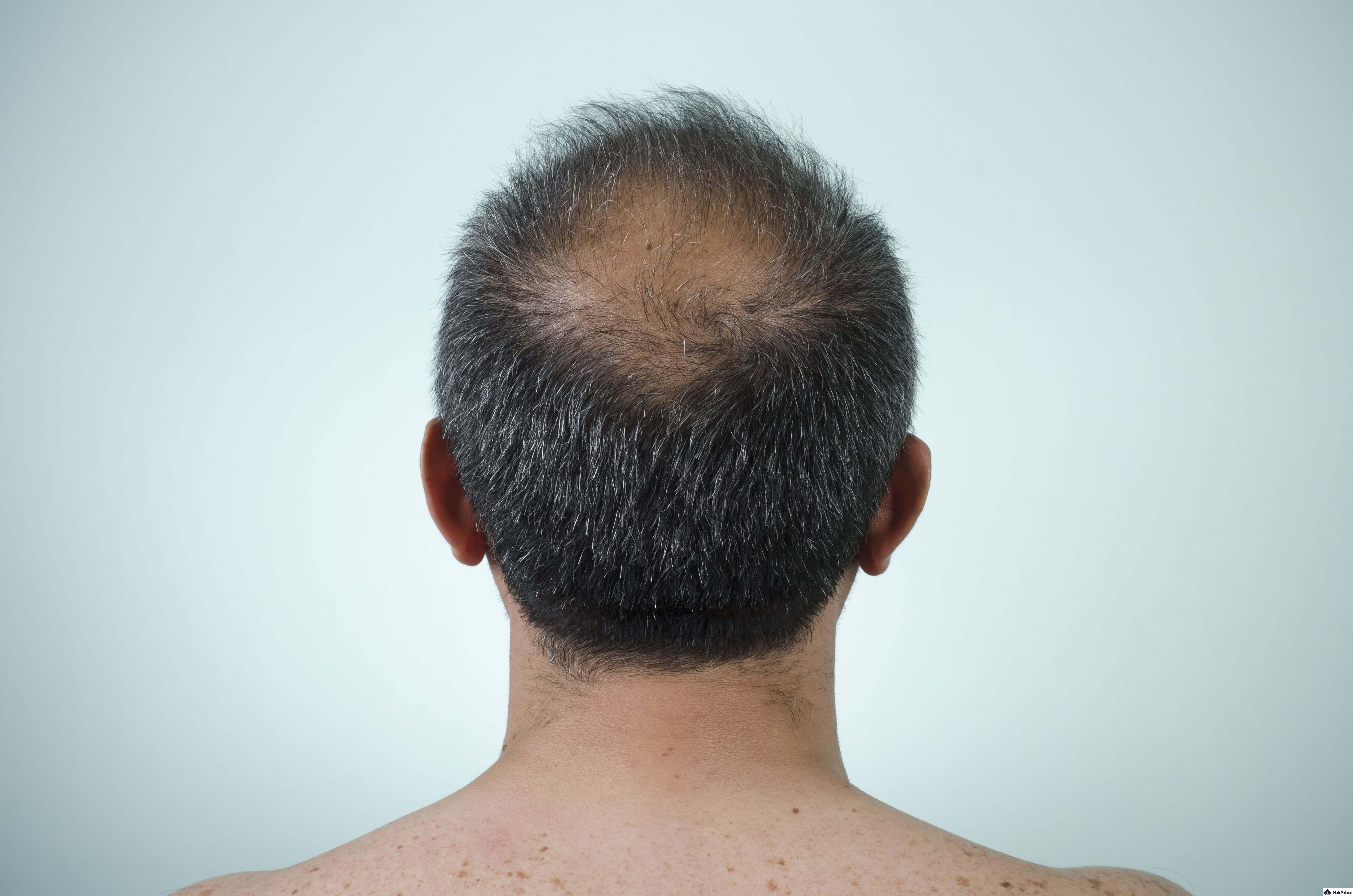 crown hair transplant results