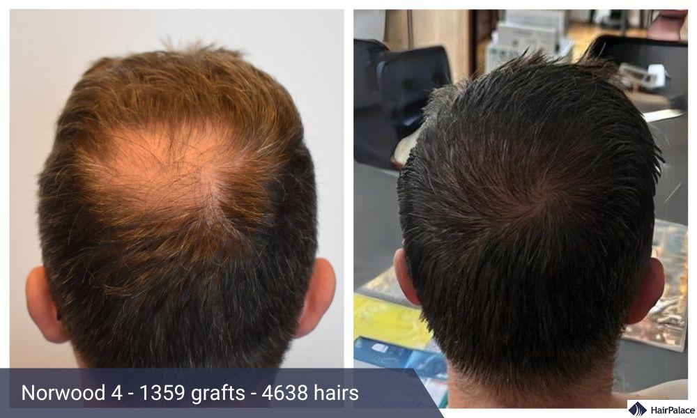 fue crown hair transplant surgery