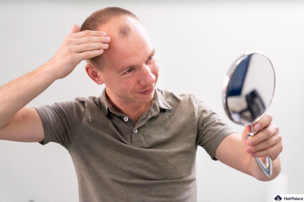 hair loss causes treatments and prevention