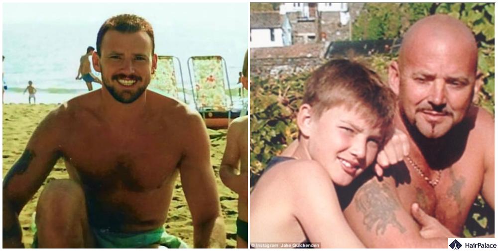 jake quickenden hair loss timeline