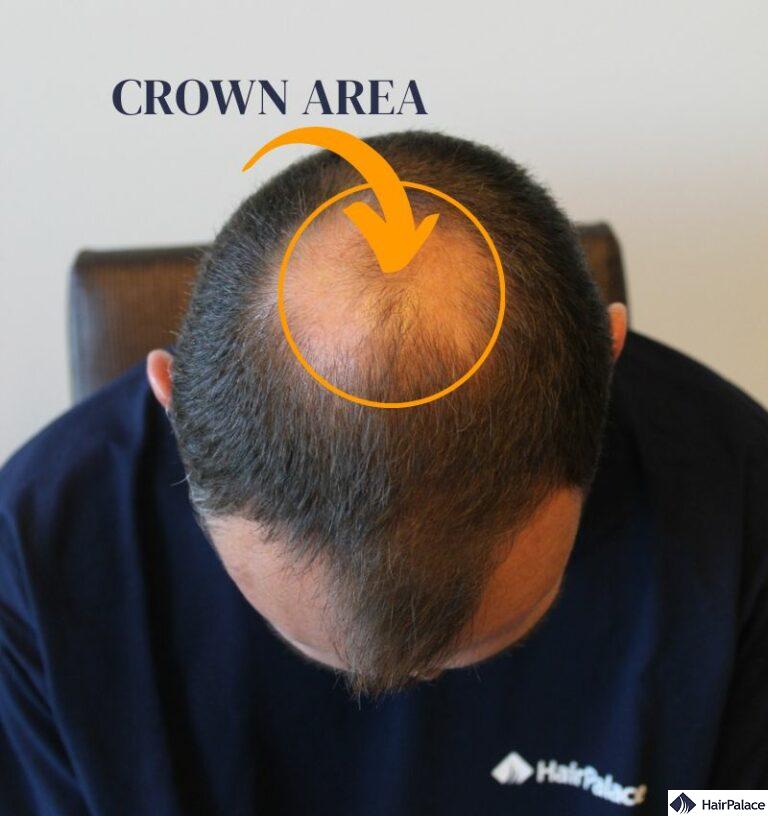 Crown Hair Transplant Is It A Good Idea Crown Hair Transplant Is It A Good Idea