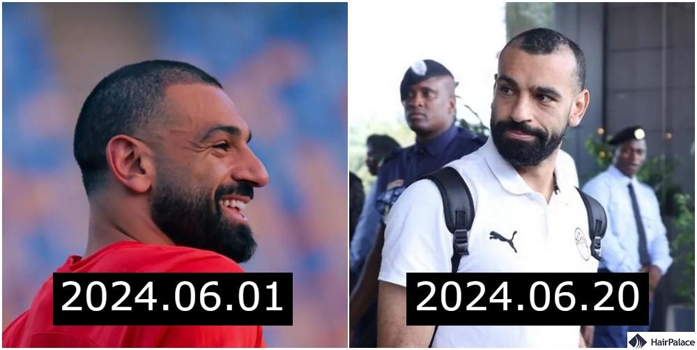 mohamed salah had a succesful hair transplant