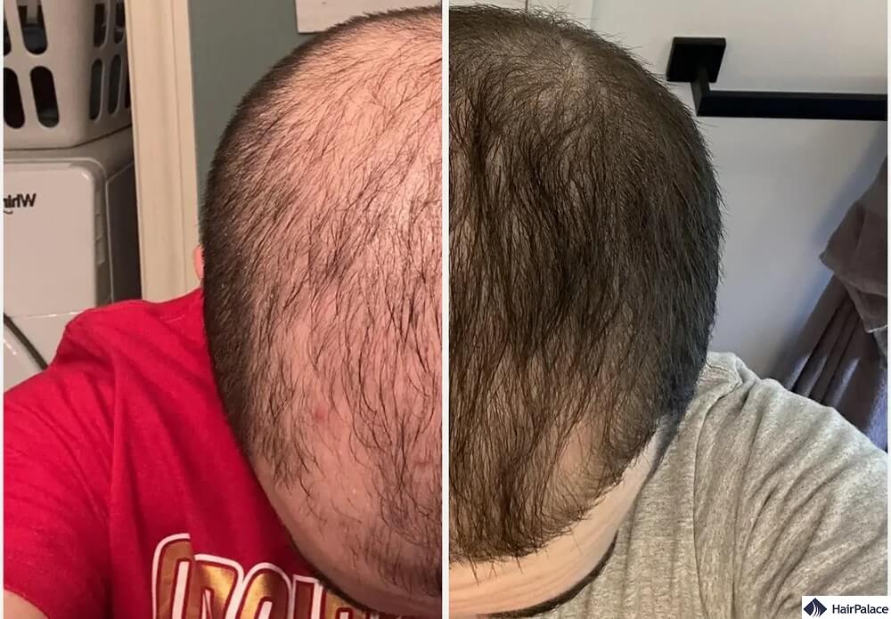 topical finasteride hair regrowth