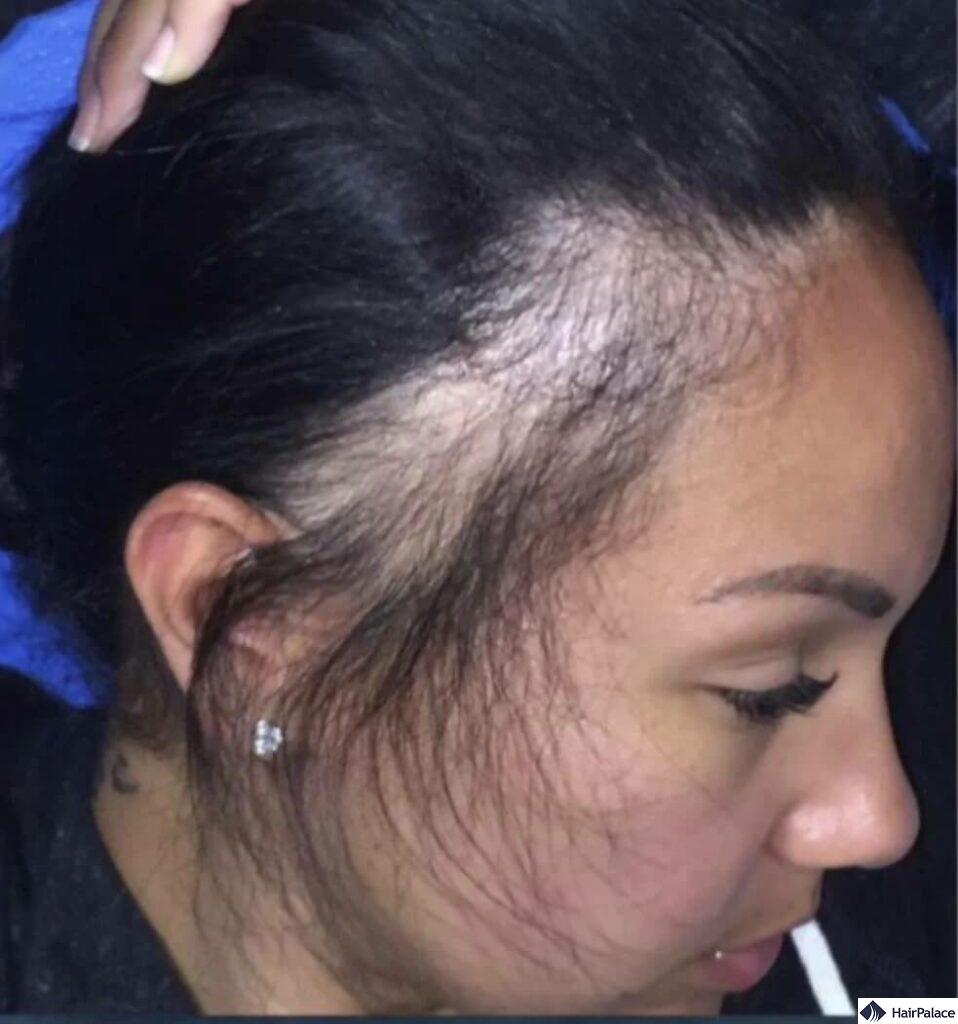 Traction Alopecia When Is It Too Late traction-alopecia-when-is-it-too-late