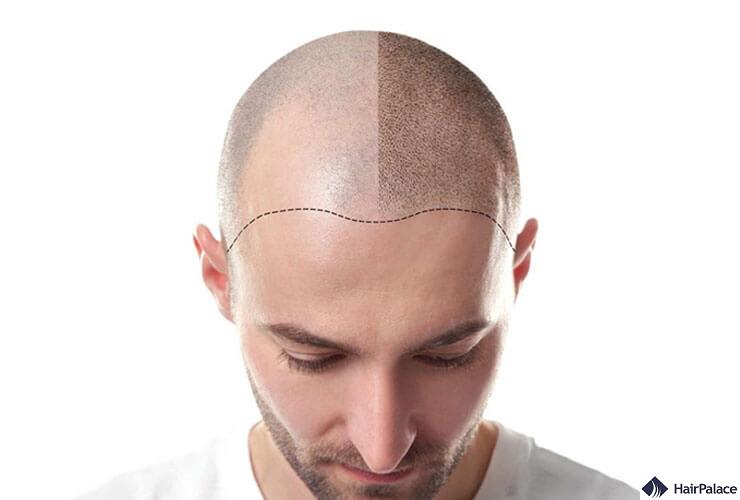 how to avoid scalp micropigmentation regrets