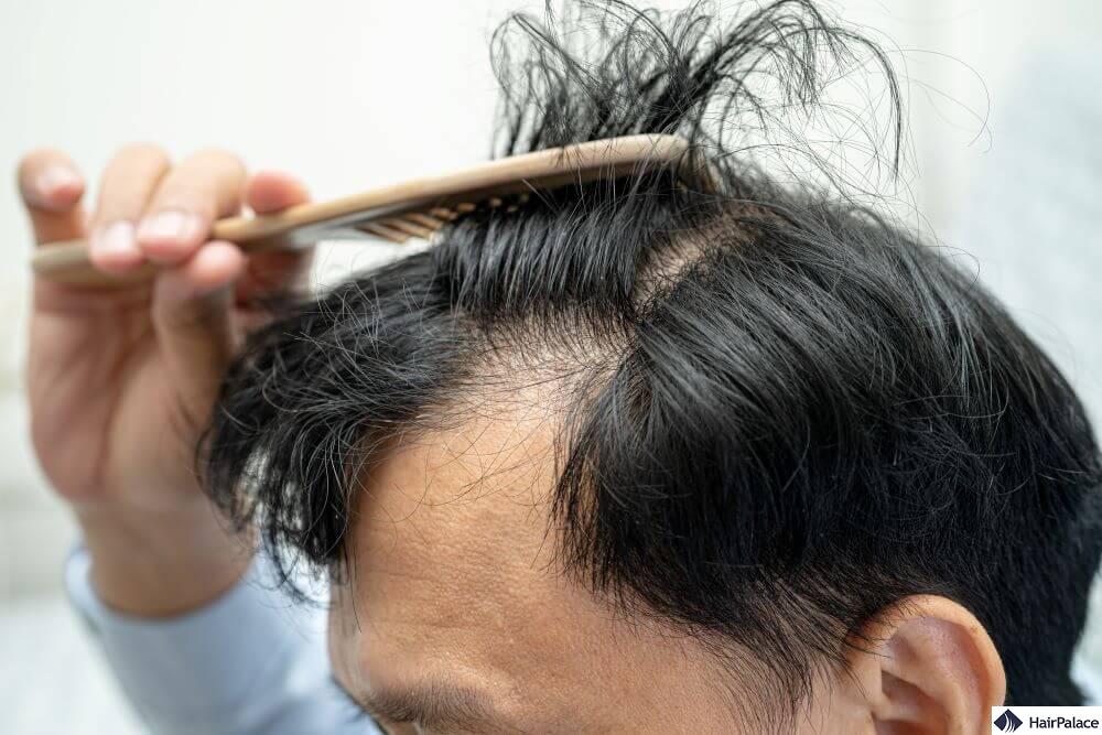 temple hair loss how to fight back