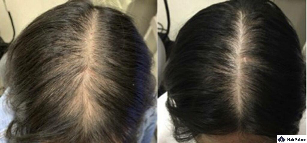 Spironolactone for Hair Loss results
