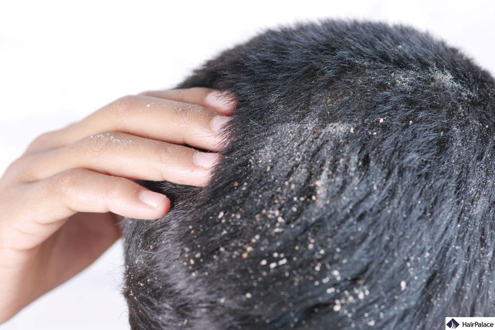 scalp psoriasis and dandruff often get mixed up