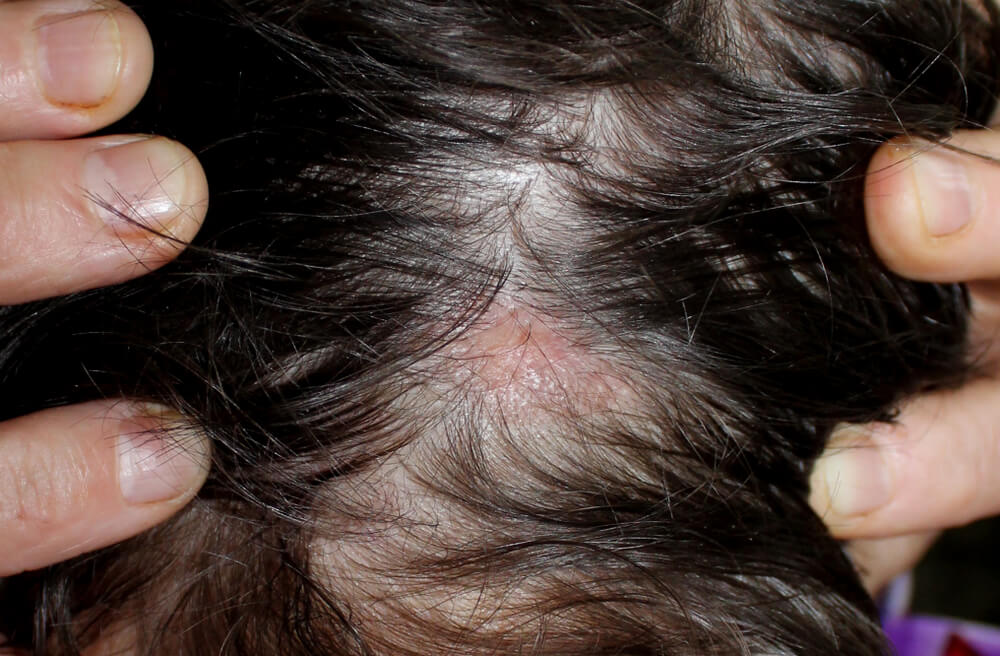 lichen planopilaris hair loss