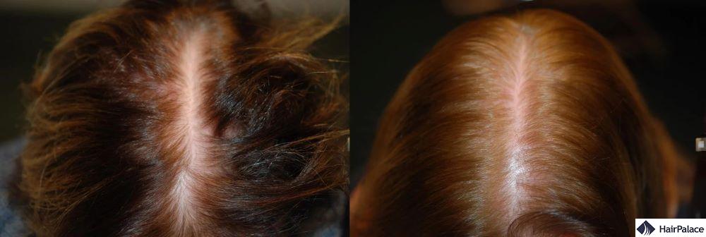 saw palmetto for hair loss results