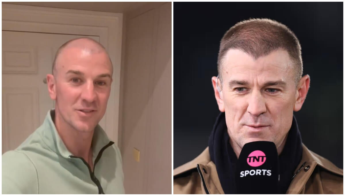 Joe Hart Hair Transplant: How did he Save his Hairline?